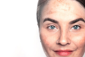 Fototapeta premium Caucasian woman shows face with pigmentation, melasma, freckles, age spots photo close up on white copy space