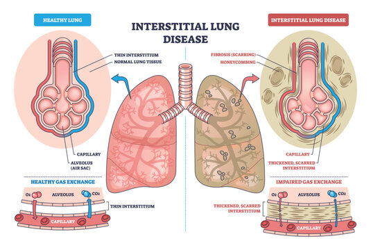 Interstitial lung disease outline contrasts healthy vs fibrotic lungs, showing alveoli thickening and impaired gas exchange, key objects, lungs, alveoli, capillaries. Outline diagram