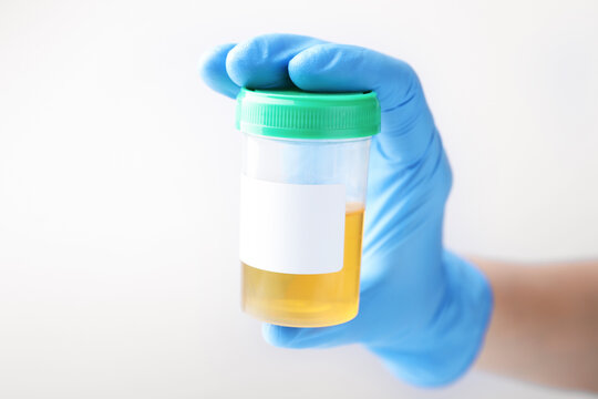 Doctor holding plastic container with urine sample on white background, closeup