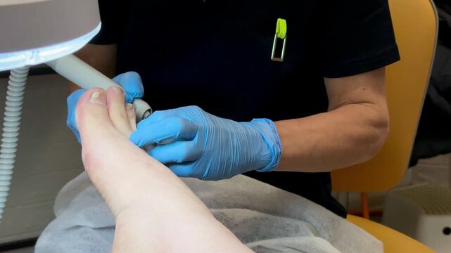 Onychomycosis. The process of treating toenails by a doctor. A dangerous fungal infection of toenails in a person sitting in an examination chair. Disease and detachment of the nail plate.