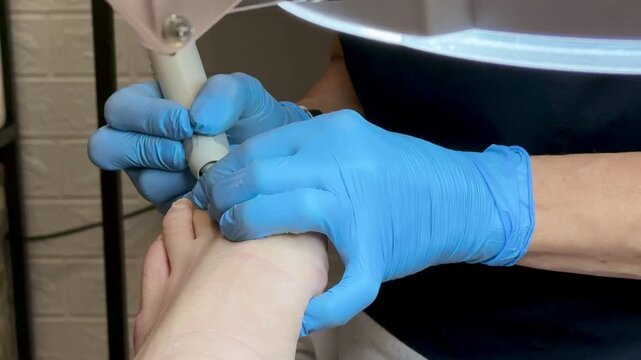 Close-up foot pedicure with electric file, podiatrist wearing blue gloves performs hardware debridement of thick fungal toenails in clinical salon, diabetic foot precautions observed, sterile.