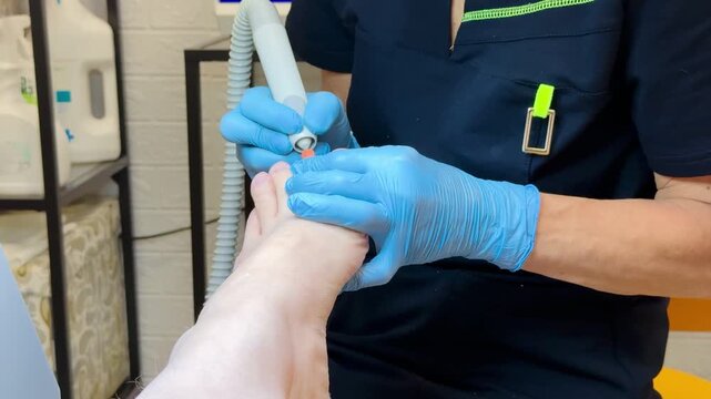 Close-up foot pedicure with electric file, podiatrist wearing blue gloves performs hardware debridement of thick fungal toenails in clinical salon, diabetic foot precautions observed, sterile.