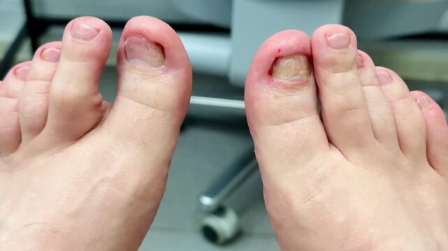 Closeup Caucasian foot after podiatry treatment showing thick yellow toenail consistent with onychomycosis, surrounding redness and mild swelling, visible debridement marks, clinical chair