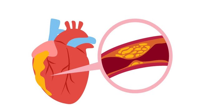 Coronary artery disease medical illustration. Heart blockage and atherosclerosis animation