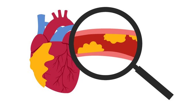 Coronary artery disease medical illustration. Heart blockage and atherosclerosis animation