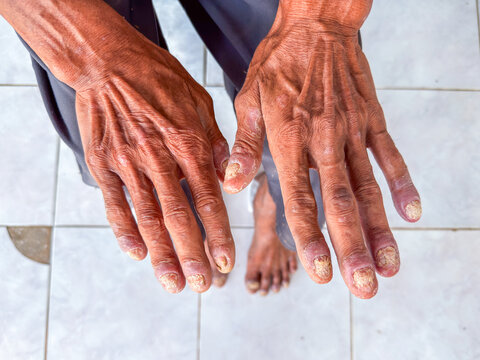 hands of the man Fungal nail infection on elderly hands close up