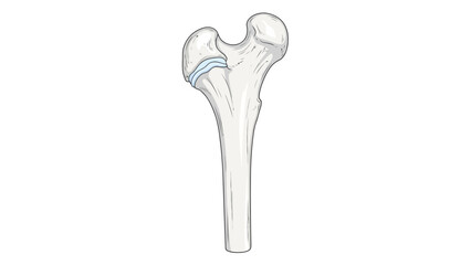 Diagram of the proximal femur with highlighted epiphyseal plate