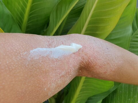 Close-up of itchy red rash on arm, eczema symptom.
close up of dry skin with uria cream.
