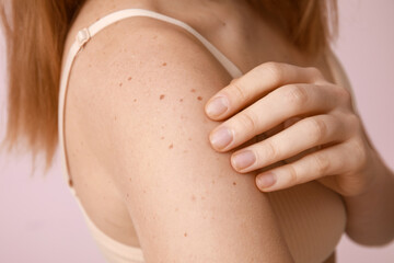 Young woman with moles on pink background, closeup