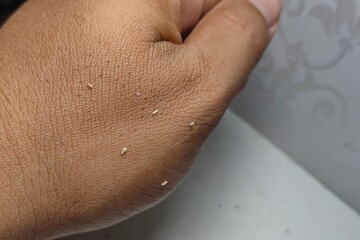 Fototapeta premium Extracted facial blackheads and sebaceous filaments placed on human hand skin.