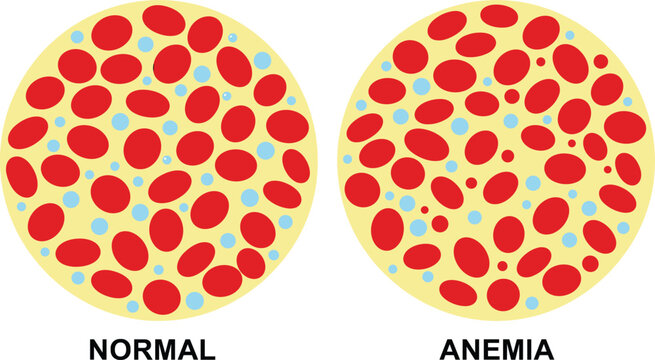 Medical vector illustration comparing normal blood cells with anemia showing a deficiency in red blood cells isolated on white background.