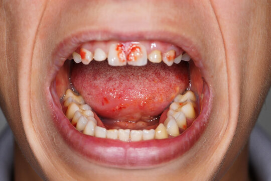 Mast Cell Activation Syndrome Child's open mouth showing bloody gums and tongue with visible teeth