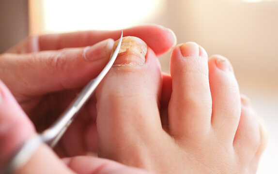 Close-up of cutting a deformed yellow nail with scissors.