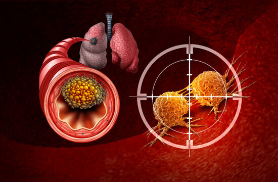 Lung Cancer Treatment and Small Cell Lung Cancers as a Central malignant tumor growth as a Metastasis growing in the lungs from a bronchi as a bronchial disease spreading in the human body as a medica