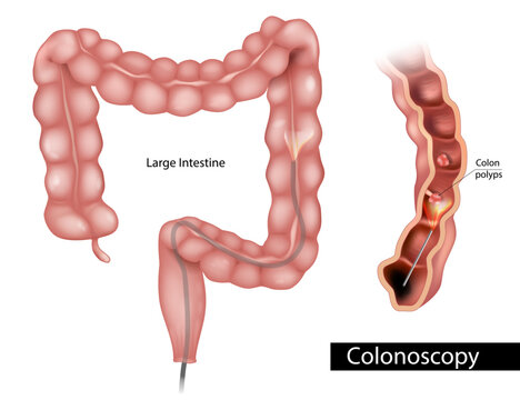 Detailed medical illustration  the colonoscopy procedure within the human large intestine. Anatomy of the colon and rectum, insertion of the endoscope, and visualization of colon polyps 