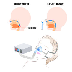 CPAP装着の状態