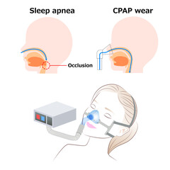 Continuous positive airway pressure (COAP) during sleep
