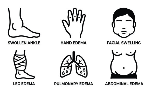 Edema types vector illustration: swollen ankle, hand, facial, leg, pulmonary, abdominal edema symptoms