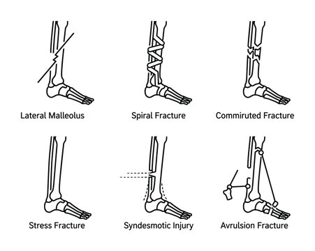 Leg bone fractures illustration: lateral malleolus, spiral, comminuted, stress, syndesmotic injury, avulsion fractures.