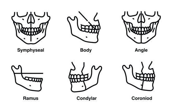 Mandibular Osteotomy Sites Diagram Vector Illustration Anatomy Jaw Surgery, Body, Symphyseal, Angle, Coronoid, Condylar, Ramus