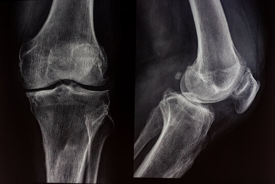 Medical Radiography of Human Knee Joint and Bone Structure. Diagnostic Imaging