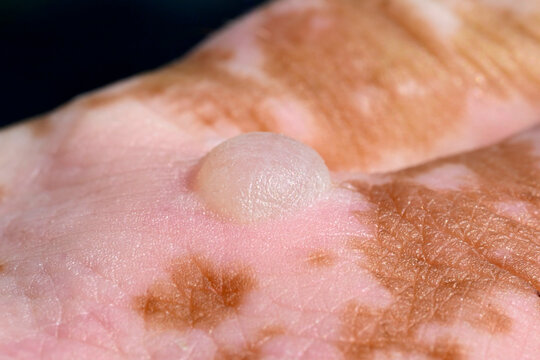 Brandblasen, Verbrennungen durch Kontakt mit Riesen-B&auml;renklau (Heracleum mantegazzianum)