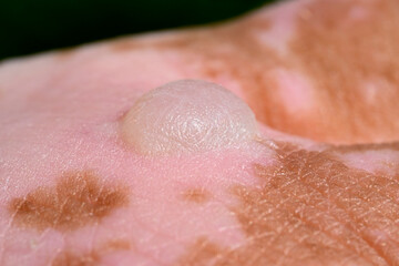 Fototapeta premium Burn blister – burns caused by skin contact with giant hogweed (Heracleum mantegazzianum)