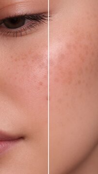 Before and After Skin Pigmentation Treatment Animation | Skincare Concept