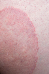 Fototapeta premium Jock itch (Tinea cruris) on the skin of a man