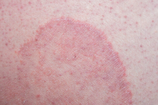Jock itch (Tinea cruris) on the skin of a man