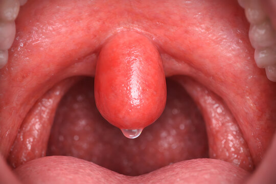 Photorealistic 3D medical-grade close-up visualization of the human oropharynx showing mild uvulitis: uvula slightly enlarged and mildly erythematous, surrounding soft palate with subtle inflammation
