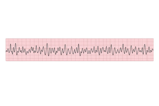 Ventricular fibrillation showing chaotic electrical activity in the heart, an emergency cardiac rhythm
