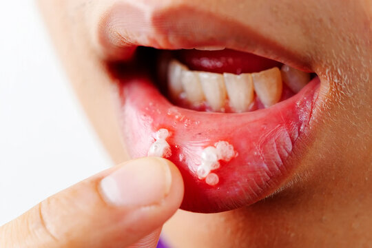 Close up of mouth showing cold sores on lower lip and finger blister