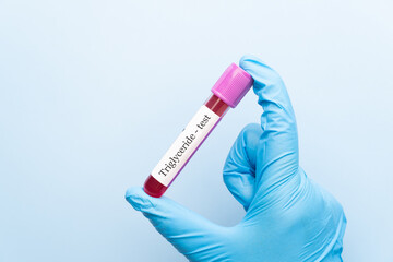 Obraz premium Blood sample tube with triglyceride cholesterol test label on medical laboratory technologist hands over blue background.