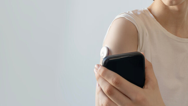 Close-up of young person using smartphone to scan continuous glucose monitor CGM sensor on their arm. Modern healthcare technology for diabetes management and blood sugar tracking