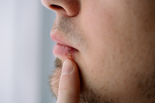 Man suffering from a visible oral herpes cold sore outbreak on his lip, indicating a viral infection and skin condition requiring medical attention and treatment