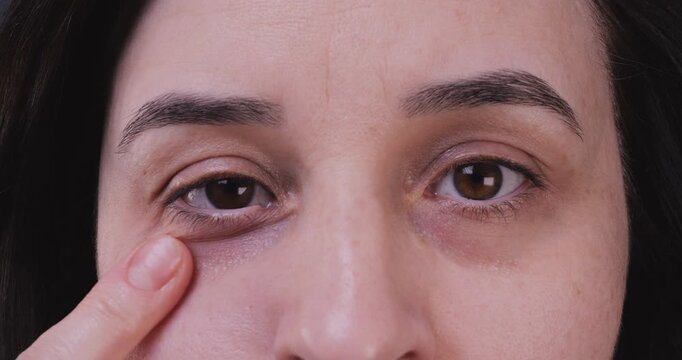 Adult woman applying anti-wrinkle and anti-dark circle eye cream, highlighting mature skincare, beauty routine, and facial care concept.