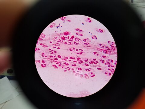 Microscopic view of a Gram-stained secretion smear showing numerous polymorphonuclear leukocytes (neutrophils). The cells display characteristic lobulated nuclei. This high-magnification clinical imag