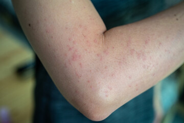Fototapeta premium Cropped shot view of rashes occur on woman arm. A rash on your arms can occur due to an allergic reaction, contact with irritants, infection, or an underlying medical condition like psoriasis.