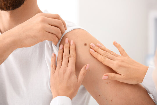 Dermatologist examining moles of male patient in clinic. Closeup