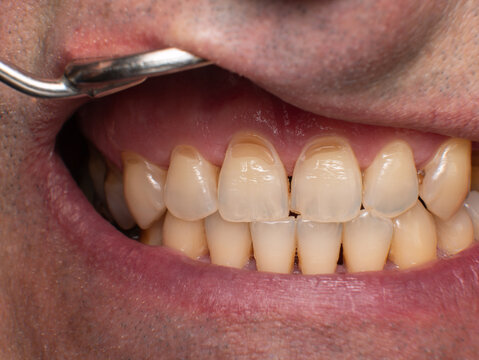 Maxillary front teeth with wedge-shaped cervical defects on all incisors, one fractured, plaque present on all teeth