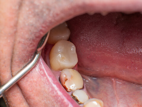Freshly filled mandibular 7th molar next to severely damaged 5th and 6th teeth with old composite fillings