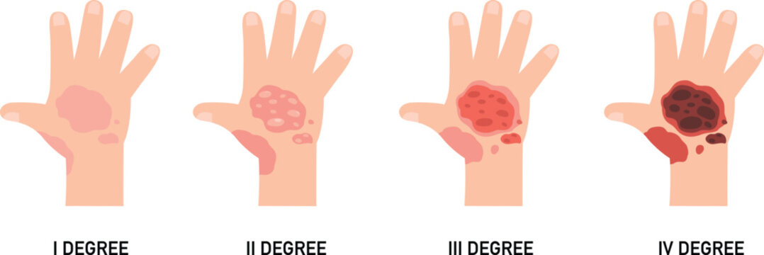 Four degree of skin burn