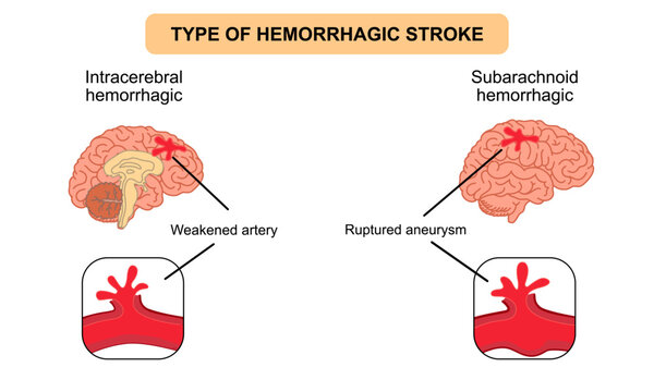 Brain stroke, hemorrhagic Intracerebral and subarachnoid. Arteriosclerosis, infarct, ischemia, thrombosis disease. Cholesterol in human blood vessels. Medical poster vector illustration.