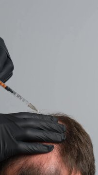 Doctor in black gloves performing scalp injection for hair loss treatment on man with thinning hair, concept of alopecia therapy and trichology procedure. Vertical video.