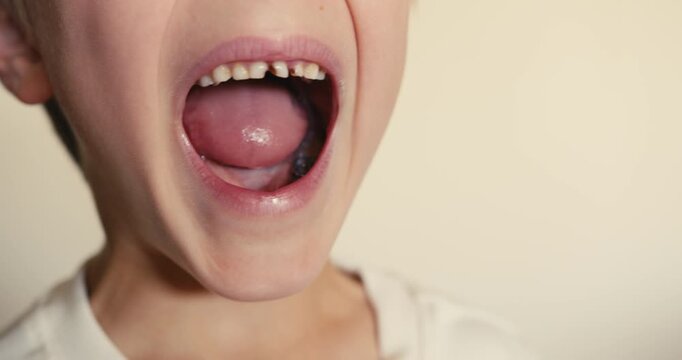 A close-up of a boy showing a damaged baby tooth inside his mouth, which is loose. Childrens dental hygiene, cavities, plaque.