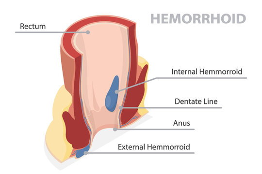 Cross section of the rectum and anal canal. Illustration of external and internal hemorrhoids structure. 3d flat vector isometric poster on white background.
