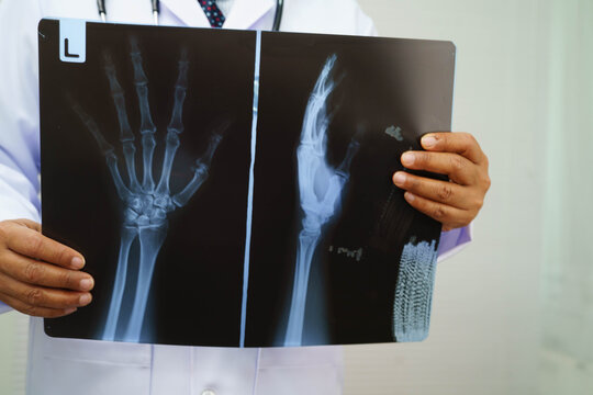 Doctor examining hand ankle joint bone radiography xray film.
