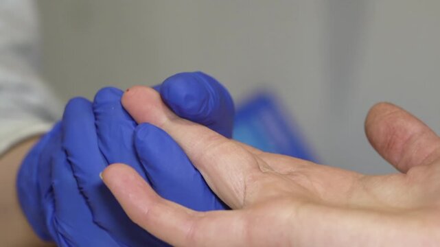 Close up view shows a medical professional wearing bright blue protective gloves carefully collecting a small blood sample from a patient's finger using a disposable pipette for testing purposes.