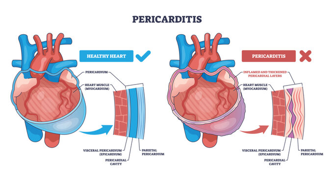 Pericarditis comparison shows healthy vs inflamed heart, highlighting pericardium layers, myocardium, and pericardial cavity, clear labels explain differences. Outline diagram
